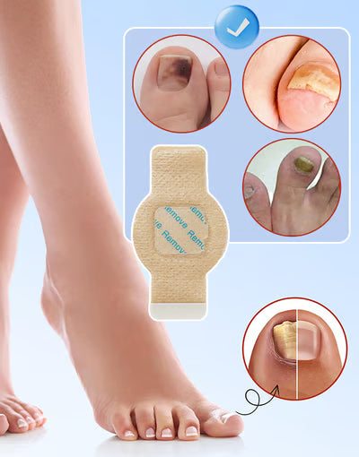 Fungal Nail Patches
