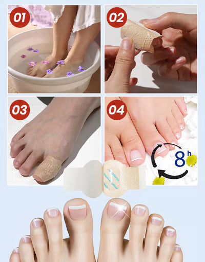 Fungal Nail Patches